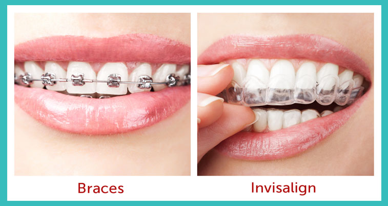 https://www.profiledentalclinictrivandrum.in/images/invisible.jpg